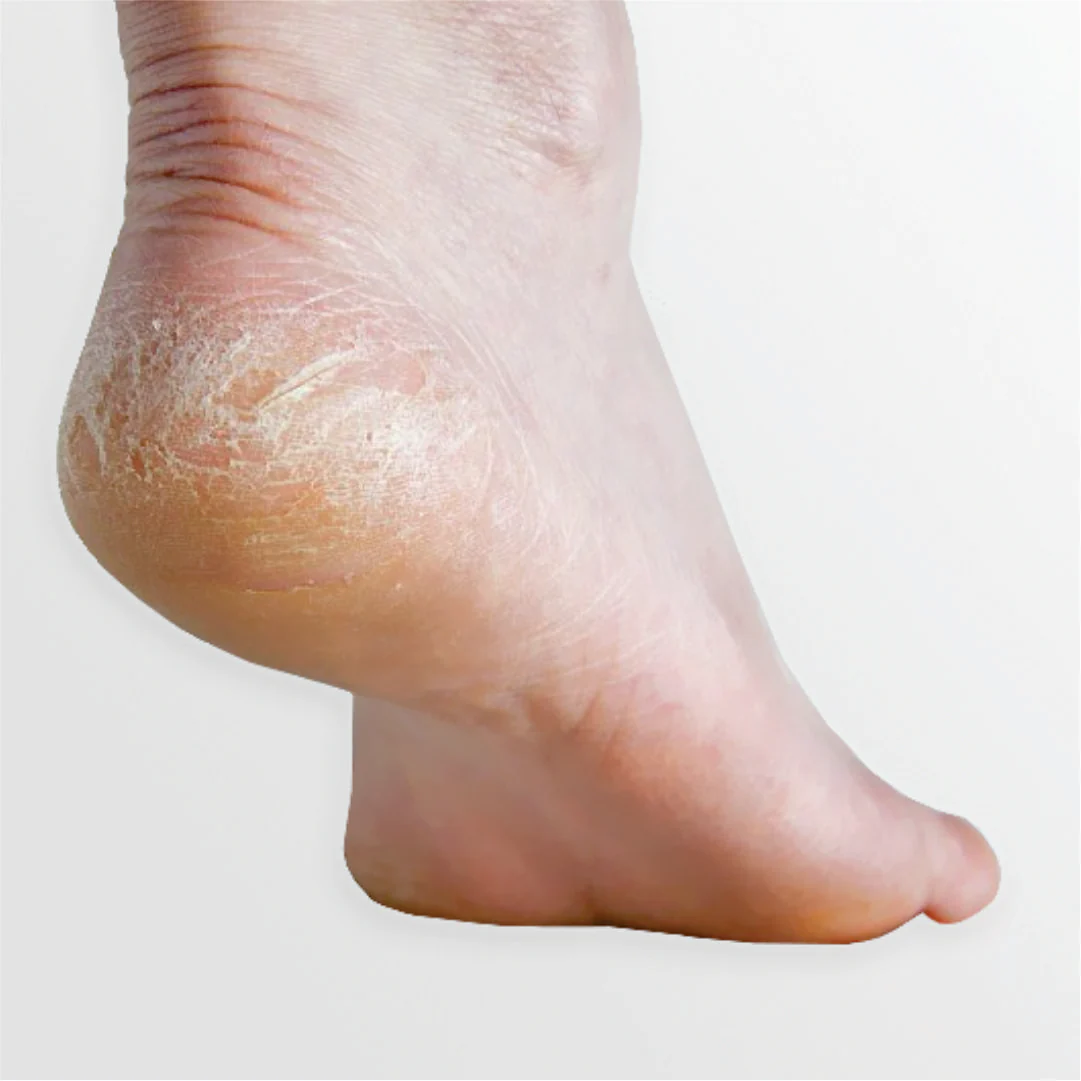 Cutting Callus Shaver - Image 2